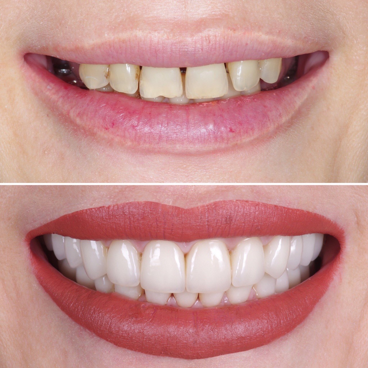 Отсутствие зубов и как следствие щели между зубами